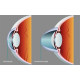 astigmatlarda-yeni-cozumler-keratokonus-ve-tedavisinde-yenilikler-ring-intacs-keraring
