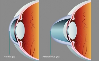 astigmatlarda-yeni-cozumler-keratokonus-ve-tedavisinde-yenilikler-ring-intacs-keraring