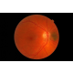 retina-dekolmani