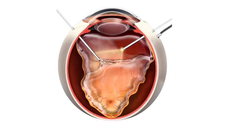 retina-dekolmaninin-onlenmesi