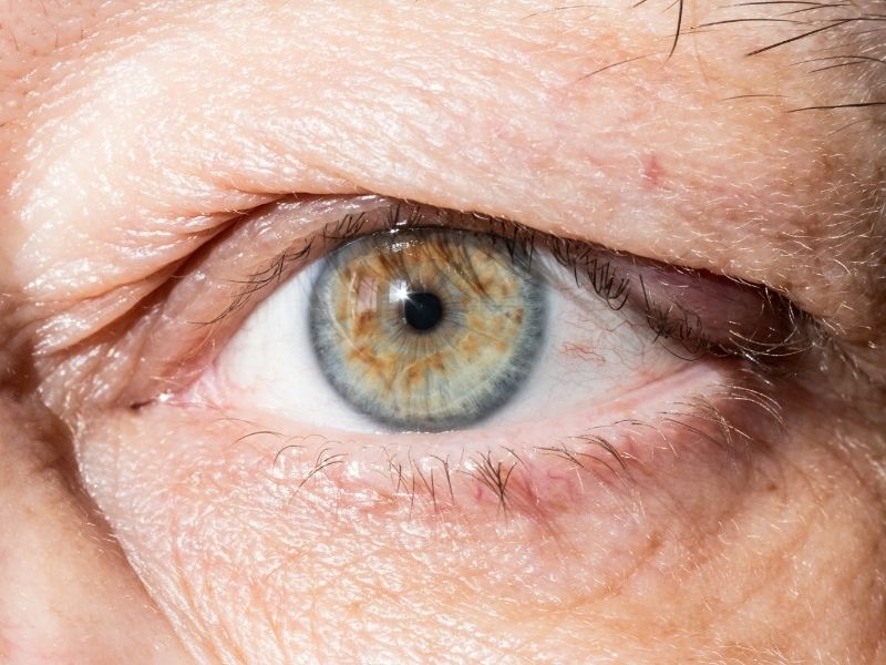 goz-kapagi-dusuk-ameliyat