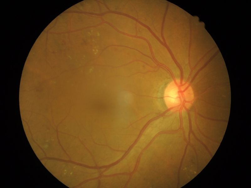 retina-yirtigi
