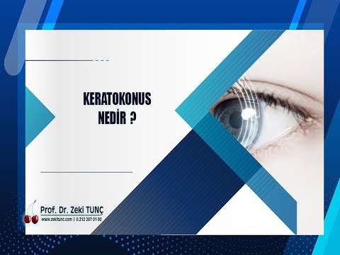 zeki tunç,keratokonus,göz sağlığı,göz hastalıkları,göz tedavileri,göz ameliyatı
