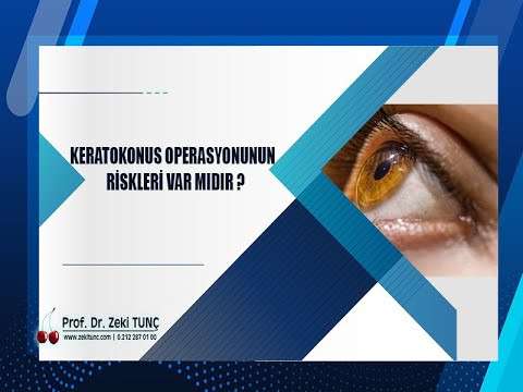 zeki tunç,keratokonus,göz hastalıkları,göz bozukluğu,göz ameliyatı
