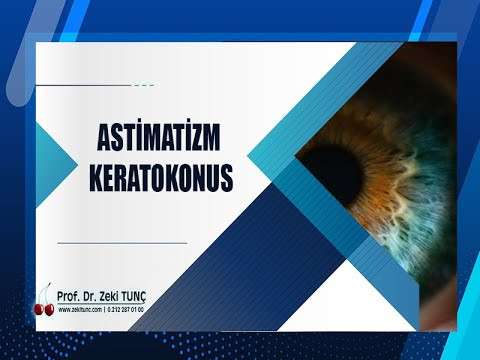 zeki tunç,astigmat,keratokonus,göz bozukluğu,göz kuruluğu,göz ameliyatı