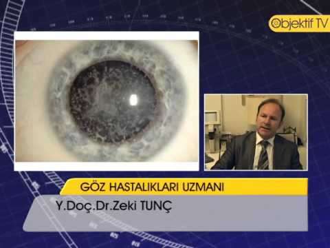 Eye (Quotation Subject),Keratoconus (Disease Or Medical Condition),Health (Industry),keratokonus,keratokonüs,ceratoconus,keratoconus,göz,mercek,astigmat,zeki tunç,lazer,fako,hipermetrop,miyop