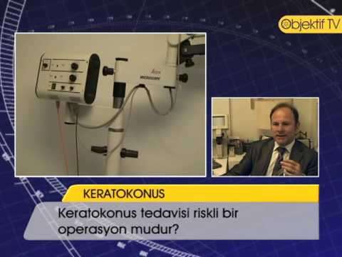 Keratoconus (Disease Or Medical Condition),Health (Industry),keratokonus,keratokonüs,ceratoconus,keratoconus,göz,mercek,astigmat,zeki tunç,lazer,fako,hipermetrop,miyop,Therapy (Literature Subject)