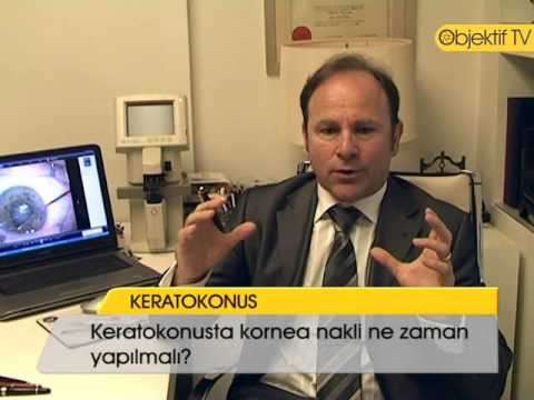 keratokonus,keratokonüs,ceratoconus,keratoconus,göz,mercek,astigmat,zeki tunç,lazer,fako,hipermetrop,miyop,Cornea (Anatomical Structure),Health (Industry)