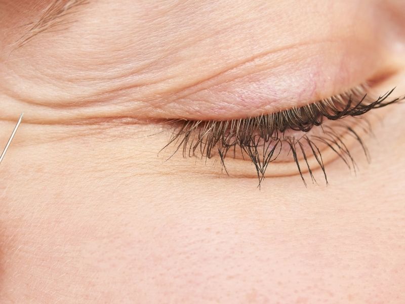 ust-goz-kapagi-ameliyat