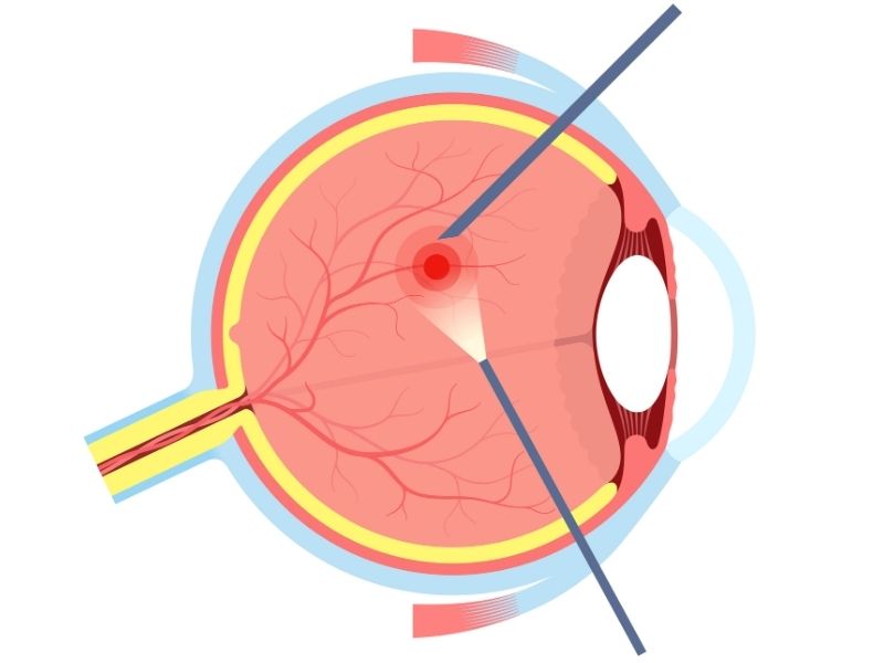 vitrektomi-nasil-uygulanir